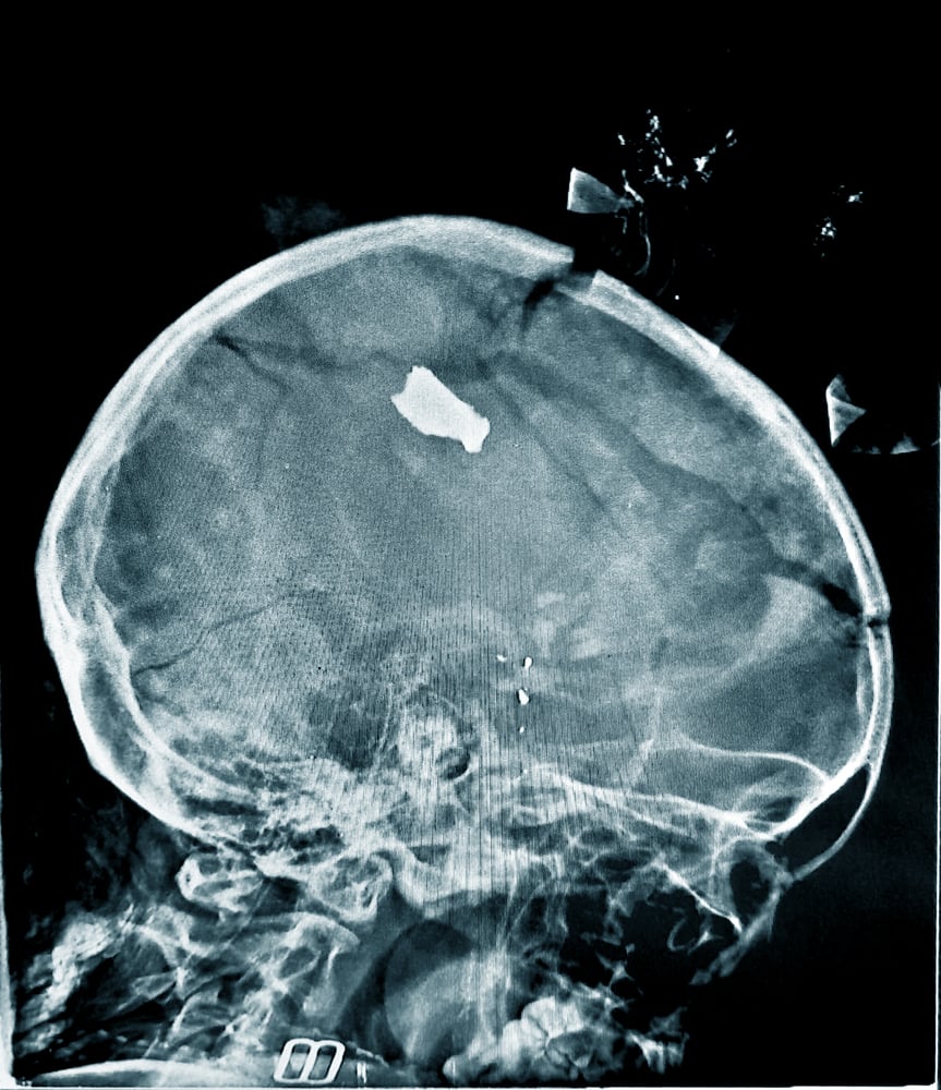 xray of a child, Sudan