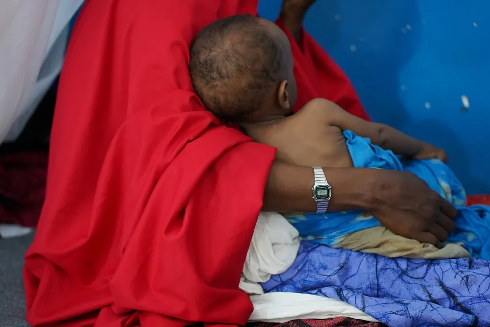 A mother supports her malnourished child resting