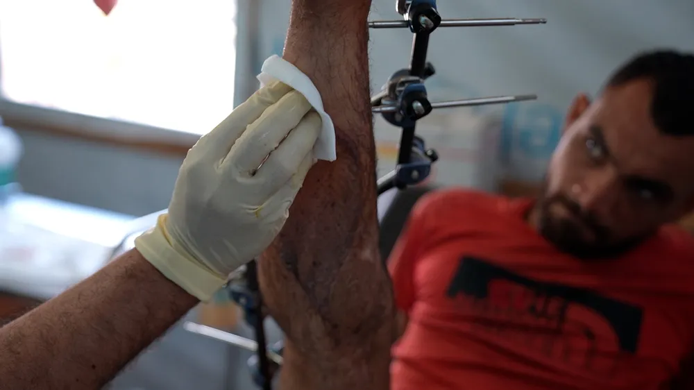 Injury of a patient forced to live with an external fixator
